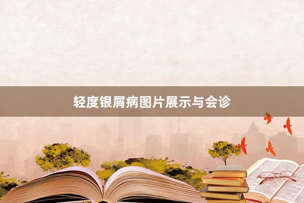 轻度银屑病图片展示与会诊